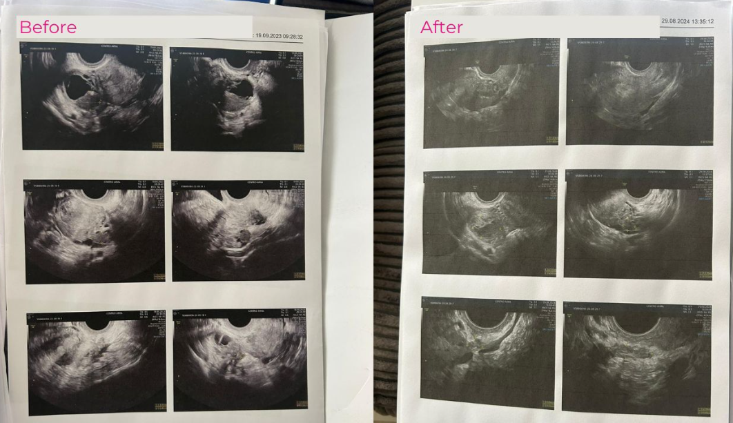 endometriosis scan Ednometriosis scan before and after